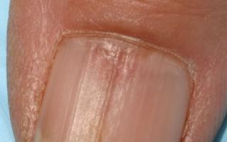 Nail dystrophy: causes of nail dystrophy on the fingers and toes and treatment with folk remedies How to treat a violation of the nail matrix