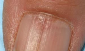 손톱 이영양증 : 손가락과 발가락의 손톱 이영양증의 원인 및 민간 요법 치료 손톱 매트릭스 위반을 치료하는 방법