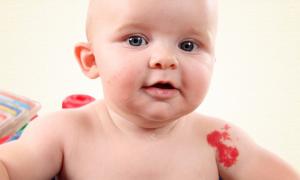 Cause delle macchie pigmentarie nei bambini Cause delle macchie pigmentarie nei bambini